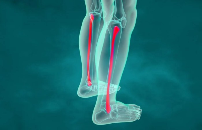 Fibula fractures shaft davidoff tibia fracture md